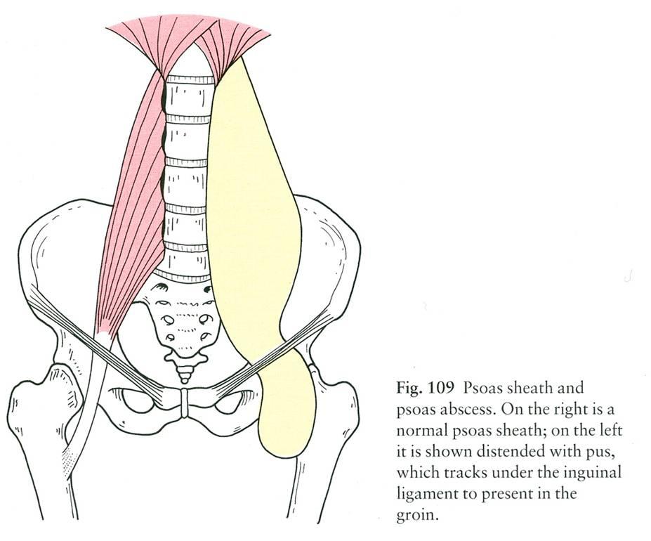 psoas-abscess